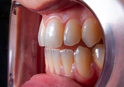 a person's mouth with teeth