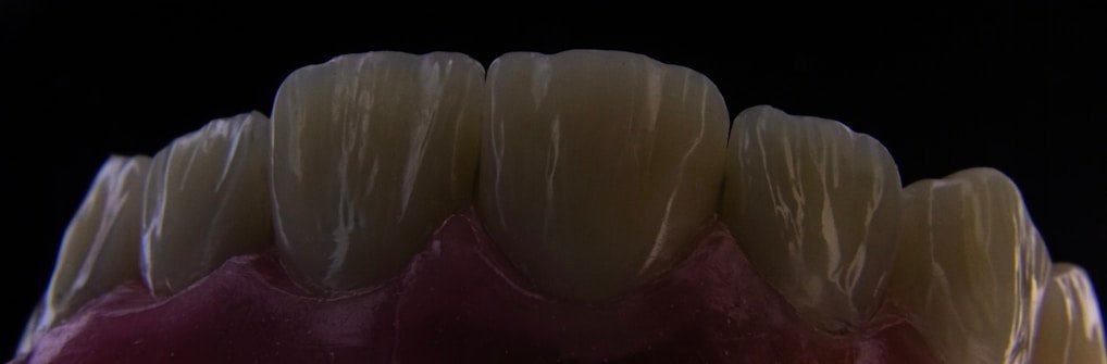 a close up of a tooth with gumpaste on it