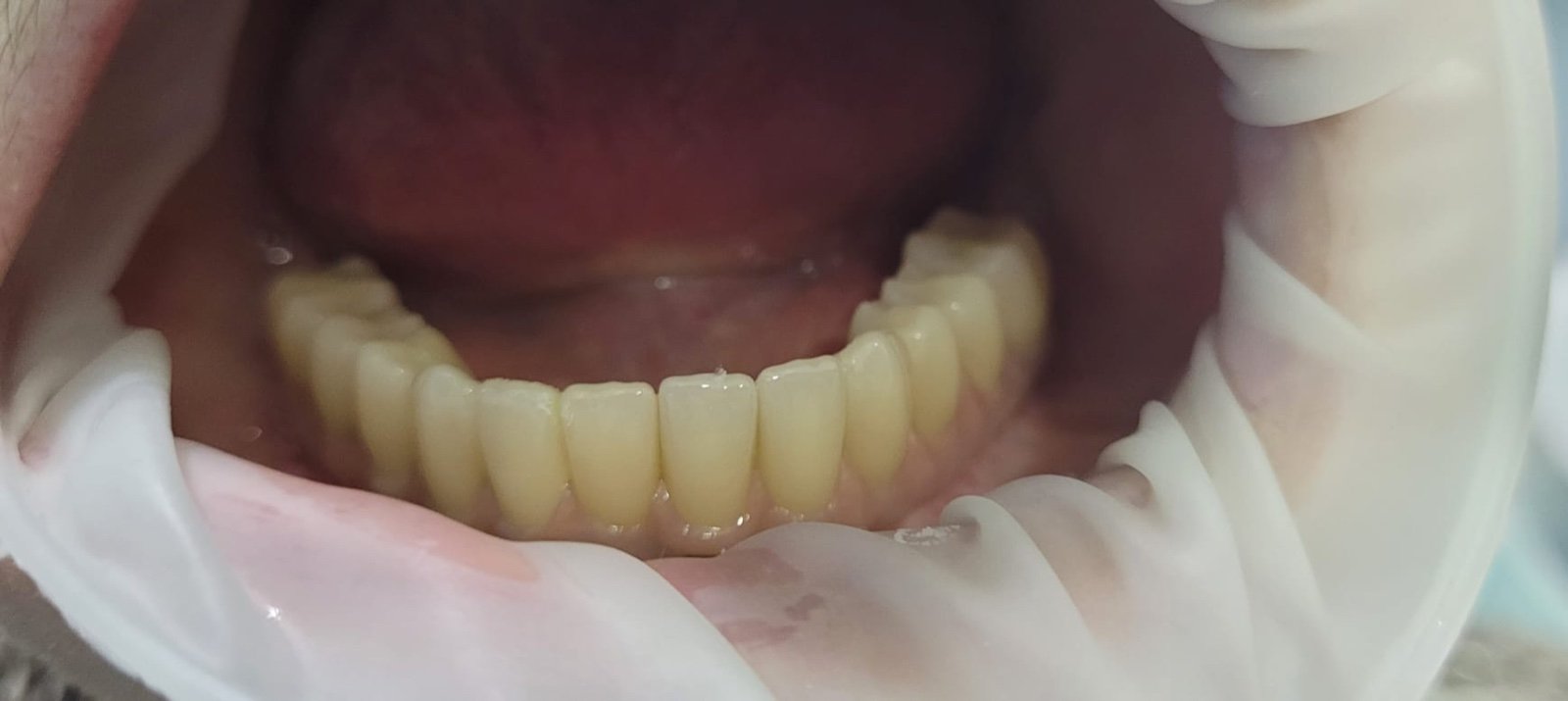 Lucrare provizorie fixă după implantare